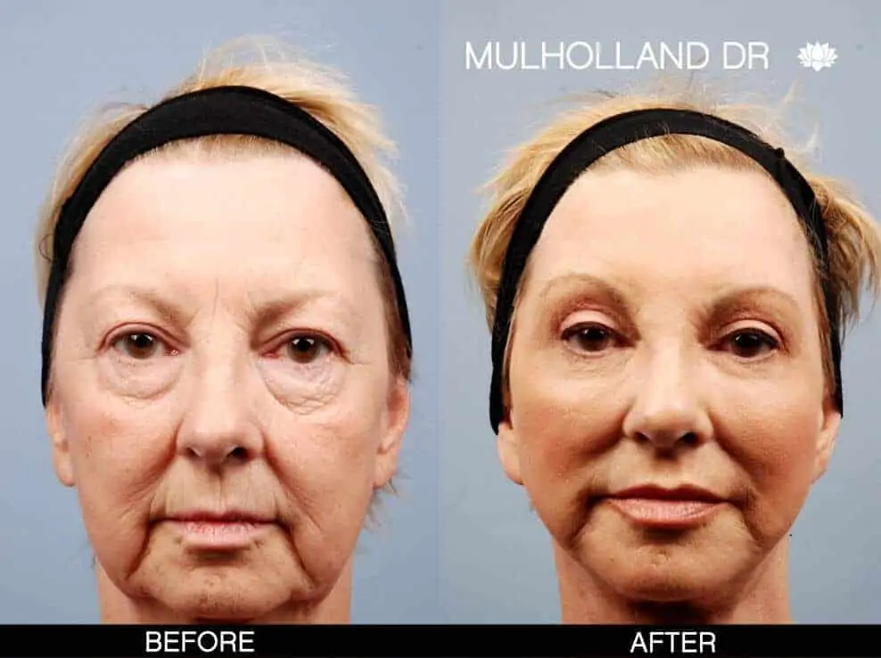Facelift - Before and After Gallery - Patient Photo 1