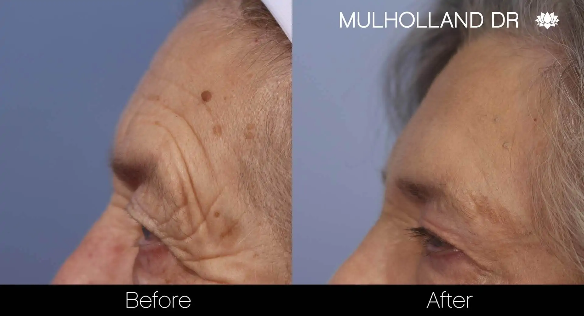 Facelift - Before and After Gallery - Patient Photo 34