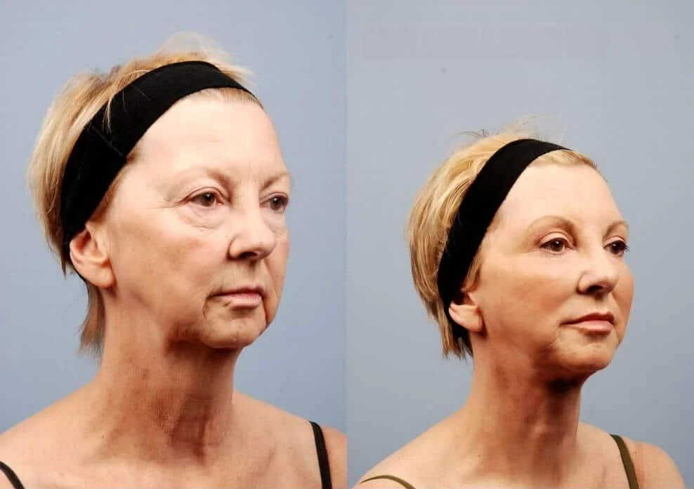 Facelift - Before and After Gallery - Patient Photo 4