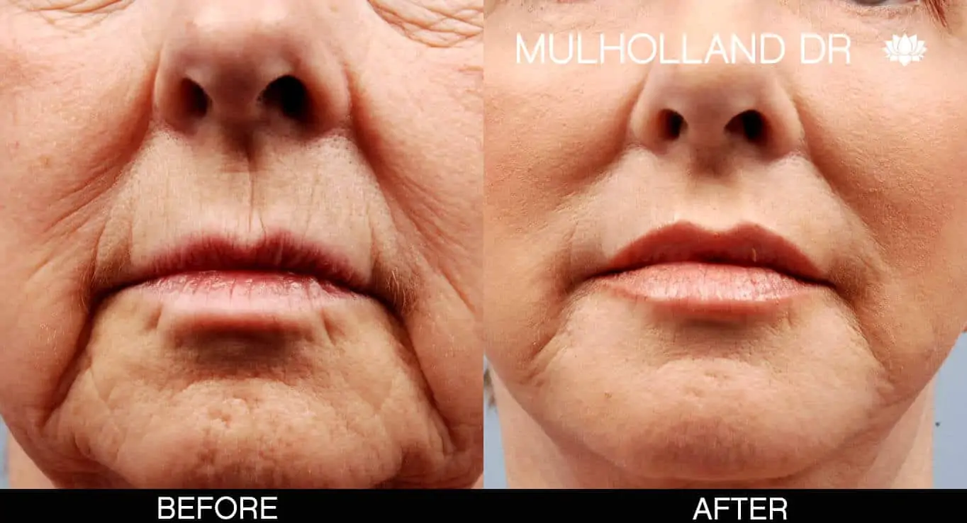 Facelift - Before and After Gallery - Patient Photo 9