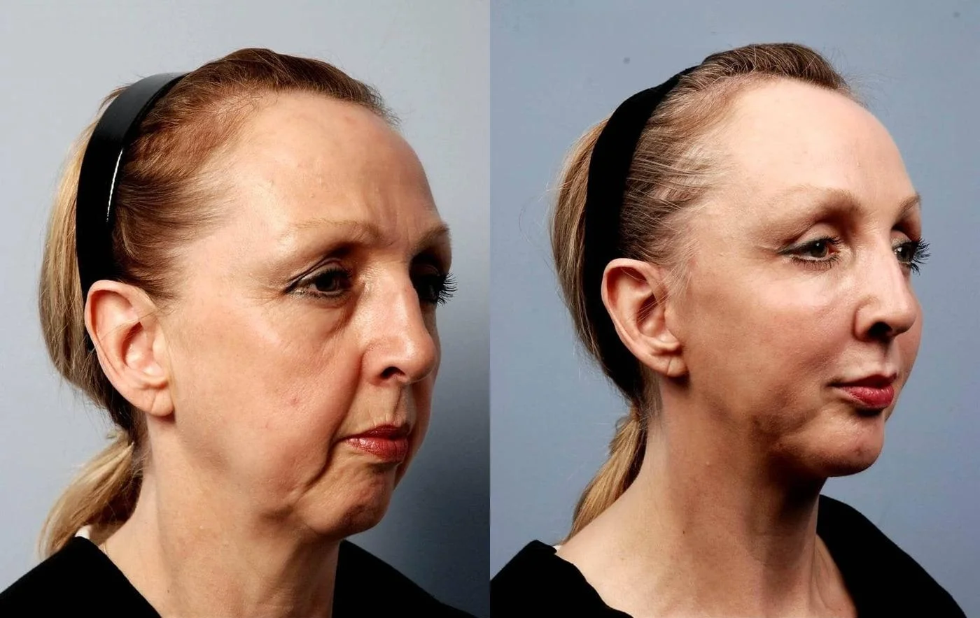Facetite - Before and After Gallery - Patient Photo 10