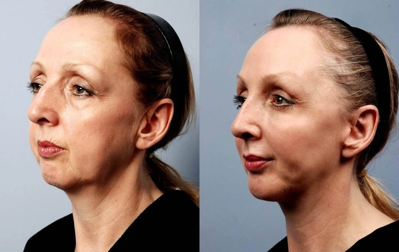 Facetite - Before and After Gallery - Patient Photo 12