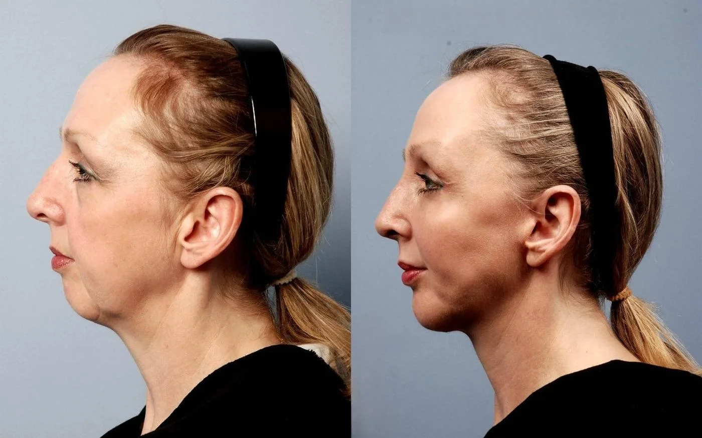 Facetite - Before and After Gallery - Patient Photo 13