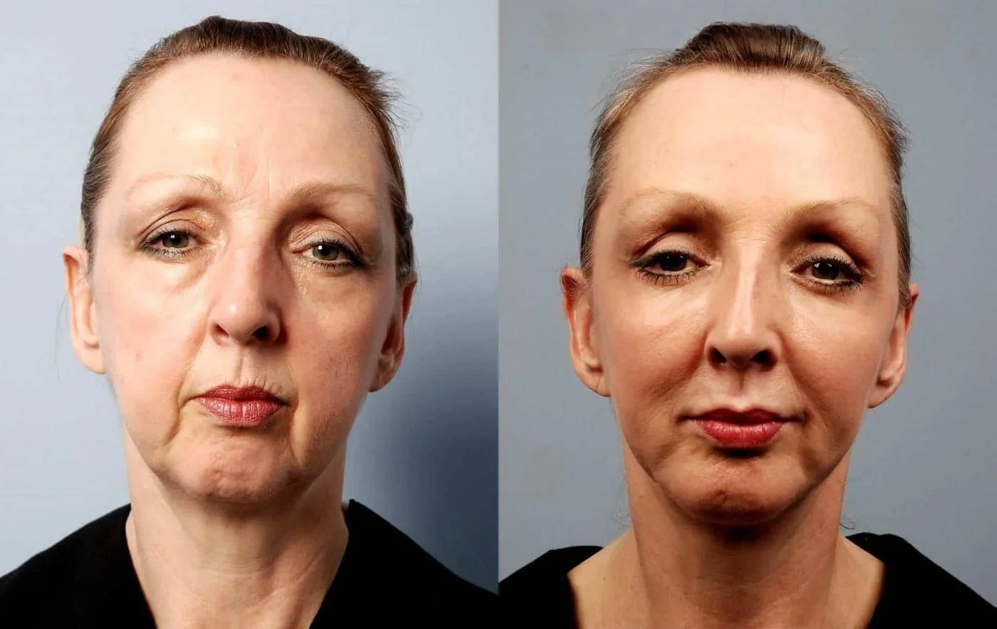 Facetite - Before and After Gallery - Patient Photo 14