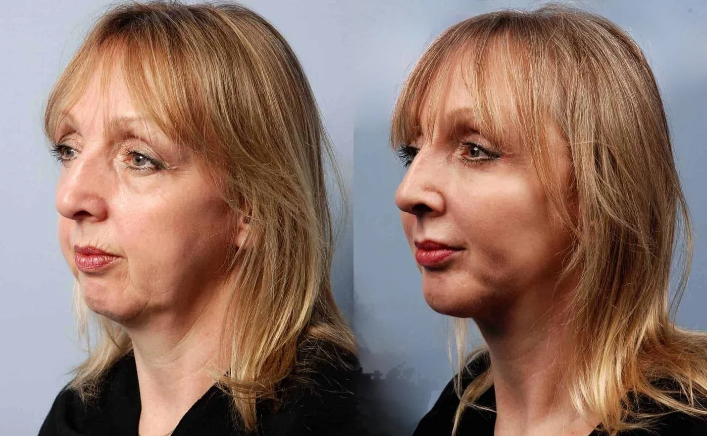 Facetite - Before and After Gallery - Patient Photo 15