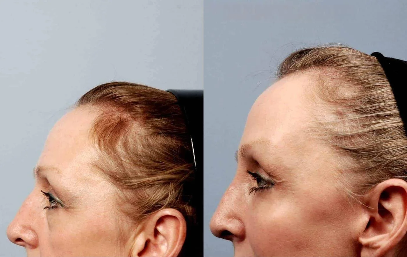 Facetite - Before and After Gallery - Patient Photo 16