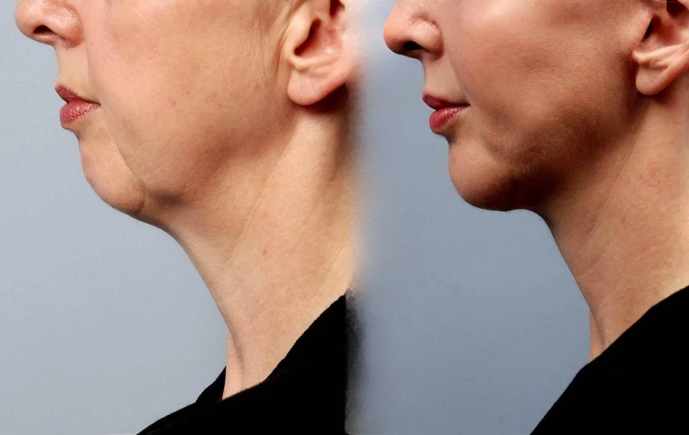 Facetite - Before and After Gallery - Patient Photo 17