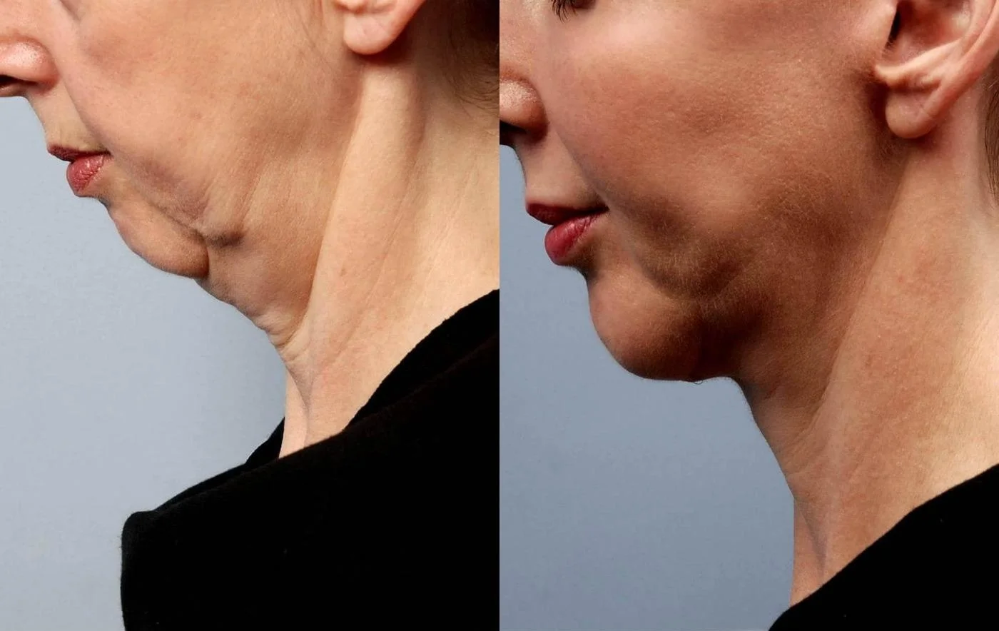 Facetite - Before and After Gallery - Patient Photo 18