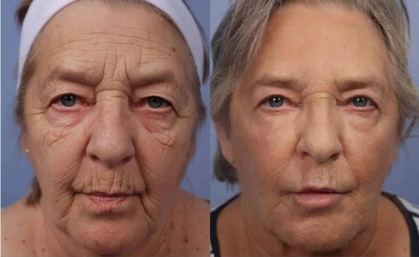 Facetite - Before and After Gallery - Patient Photo 19