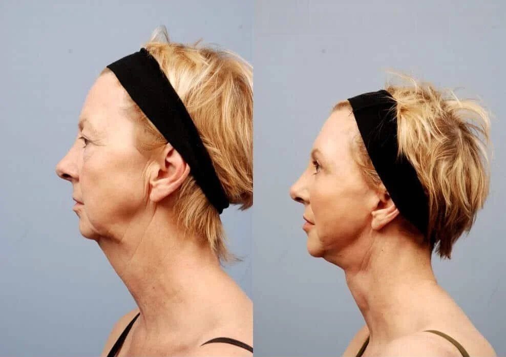 Facetite - Before and After Gallery - Patient Photo 2