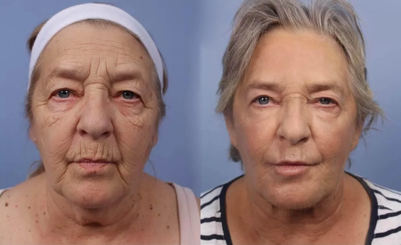 Facetite - Before and After Gallery - Patient Photo 20