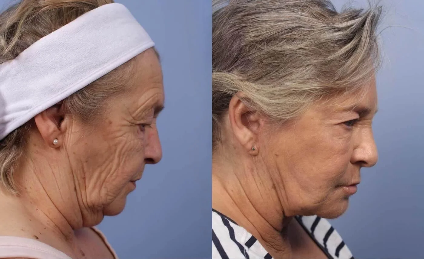 Facetite - Before and After Gallery - Patient Photo 25