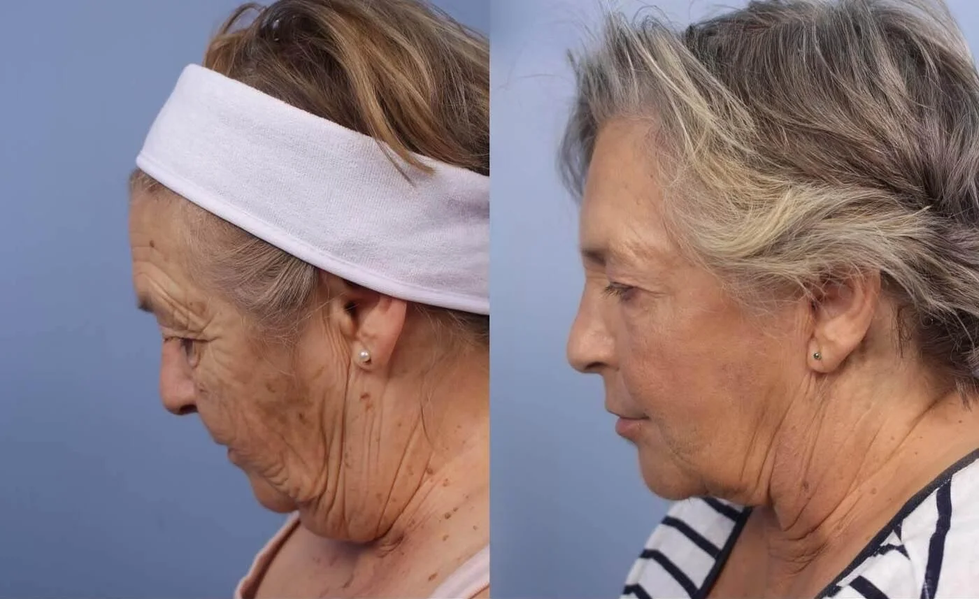 Facetite - Before and After Gallery - Patient Photo 26