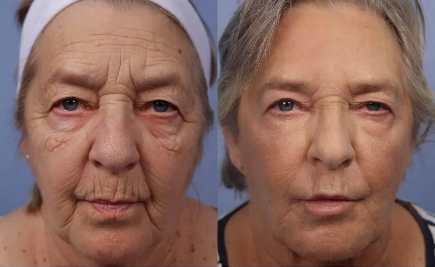 Facetite - Before and After Gallery - Patient Photo 27
