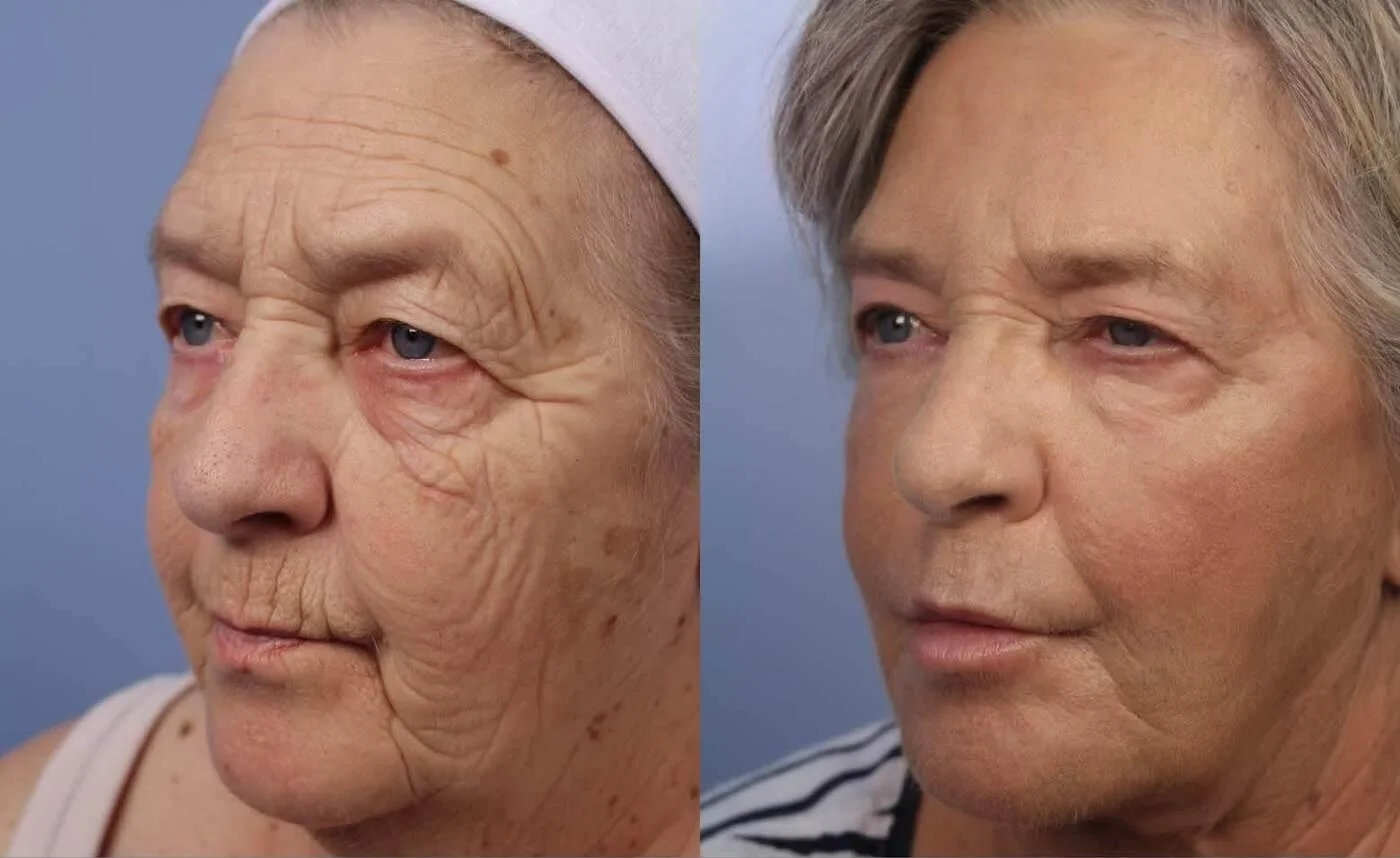 Facetite - Before and After Gallery - Patient Photo 28