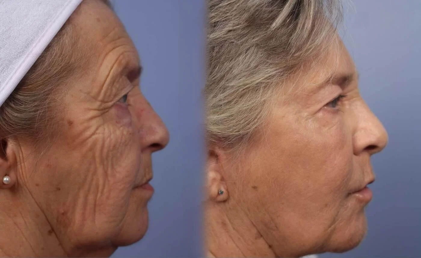 Facetite - Before and After Gallery - Patient Photo 31