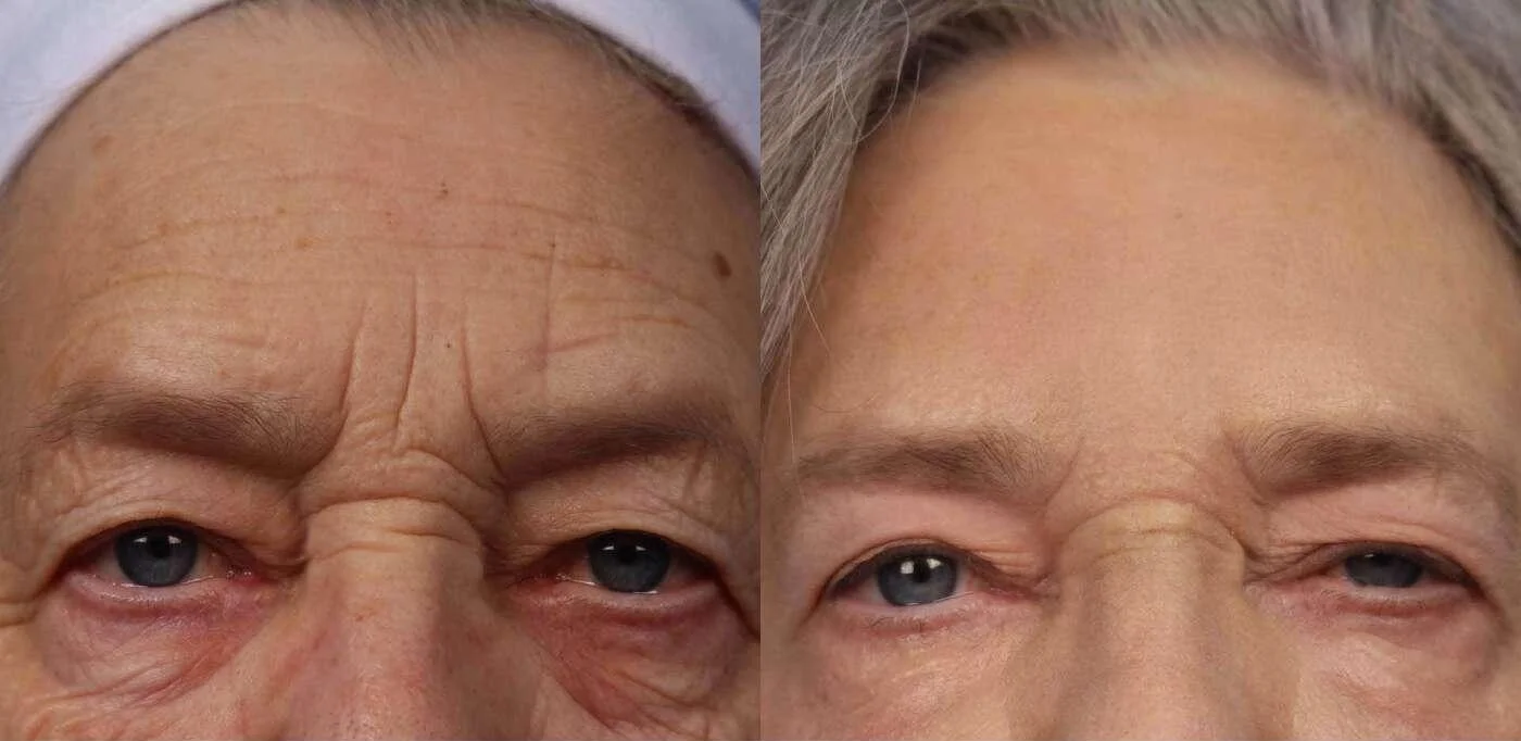 Facetite - Before and After Gallery - Patient Photo 32