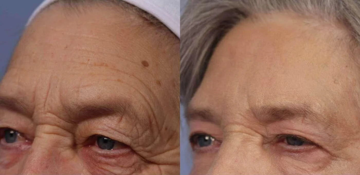 Facetite - Before and After Gallery - Patient Photo 33