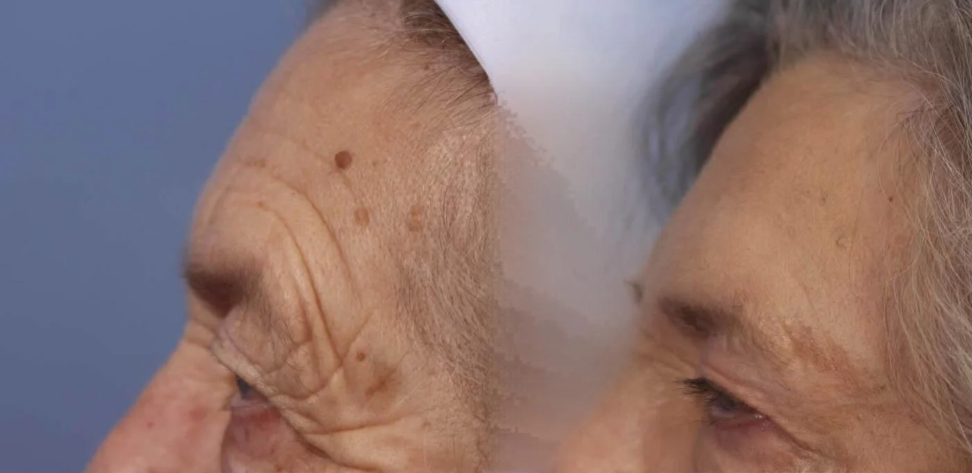 Facetite - Before and After Gallery - Patient Photo 34