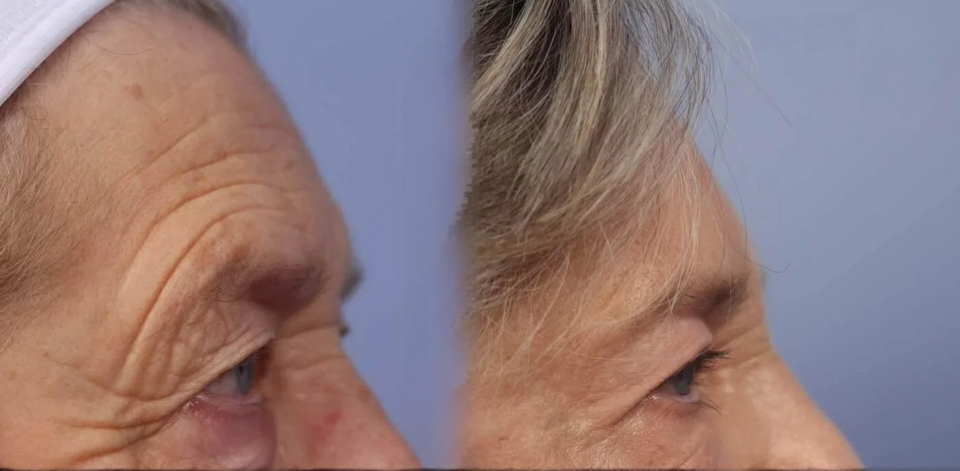 Facetite - Before and After Gallery - Patient Photo 36