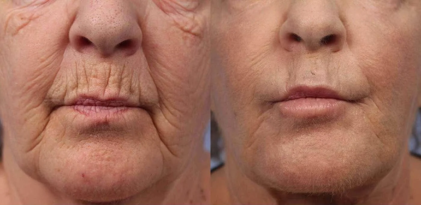 Facetite - Before and After Gallery - Patient Photo 37