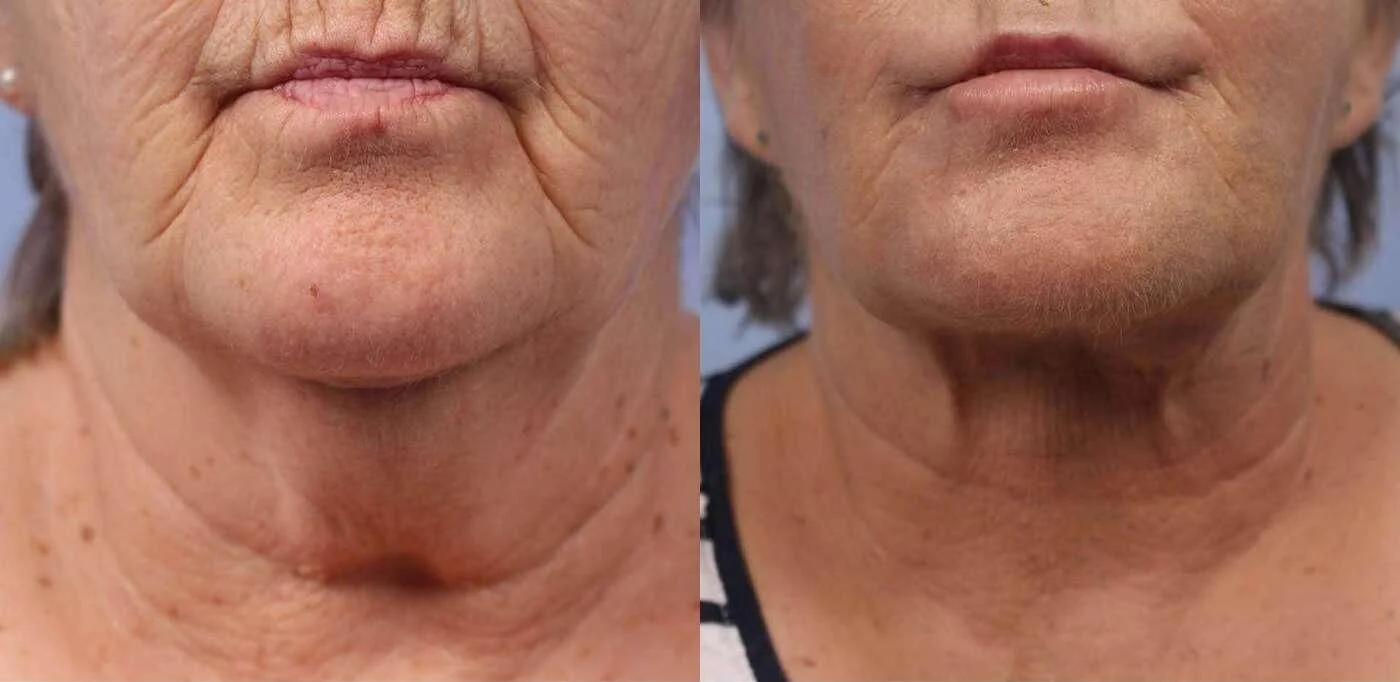 Facetite - Before and After Gallery - Patient Photo 38