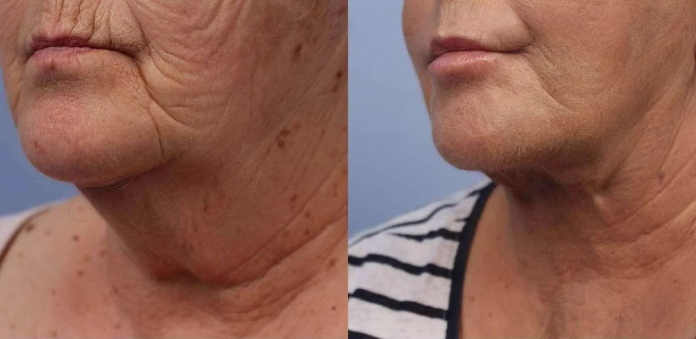 Facetite - Before and After Gallery - Patient Photo 40