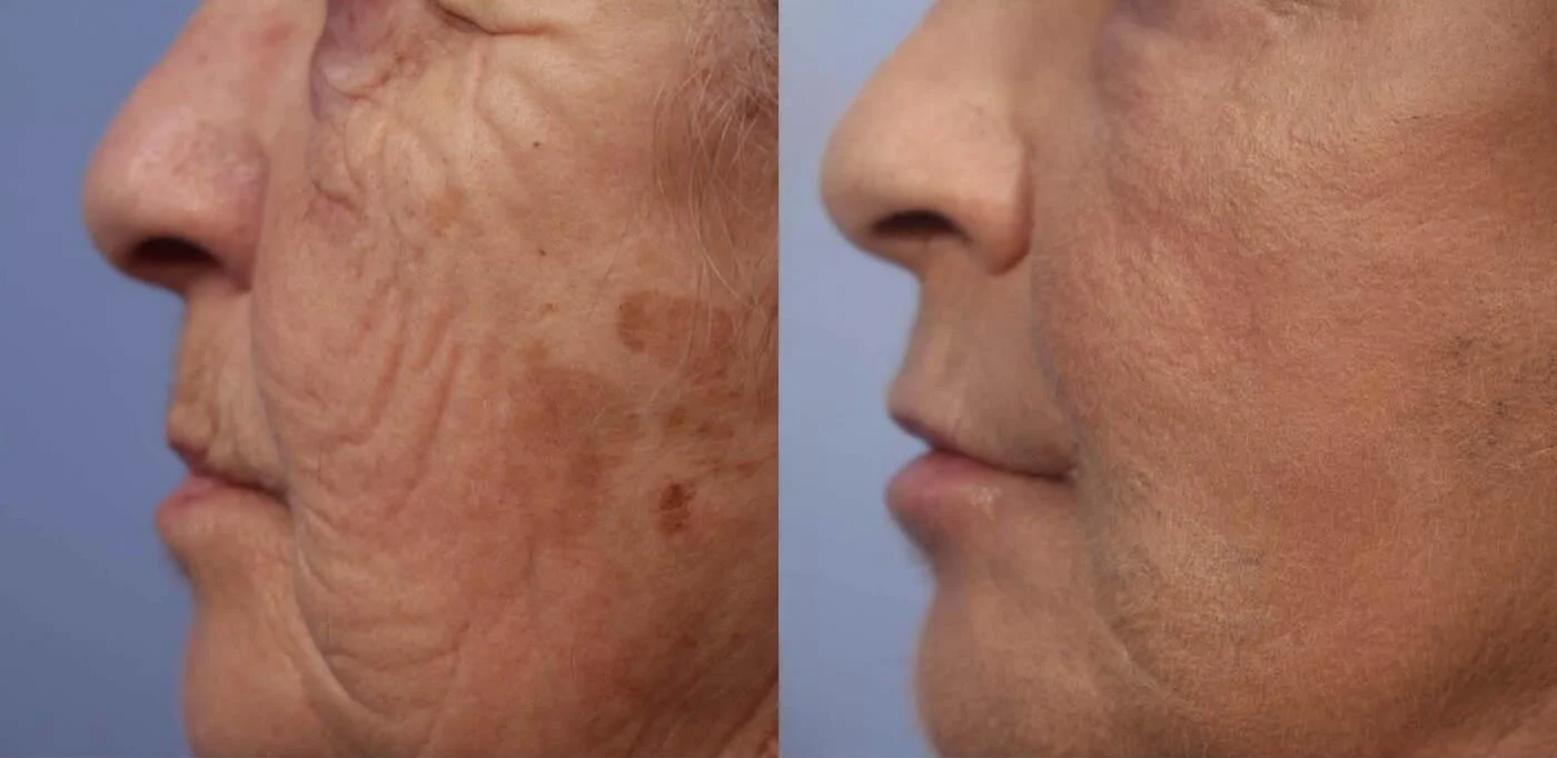 Facetite - Before and After Gallery - Patient Photo 41