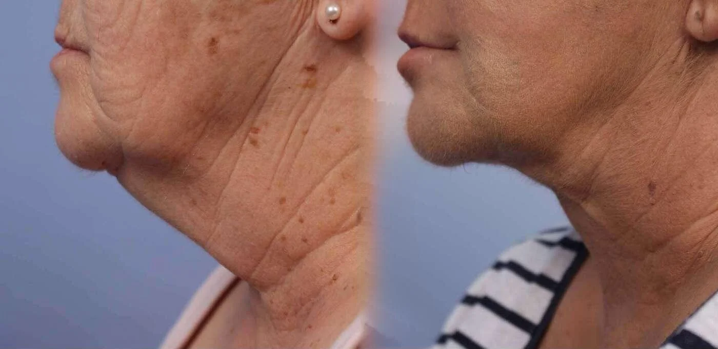 Facetite - Before and After Gallery - Patient Photo 42