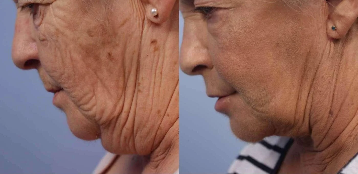 Facetite - Before and After Gallery - Patient Photo 44