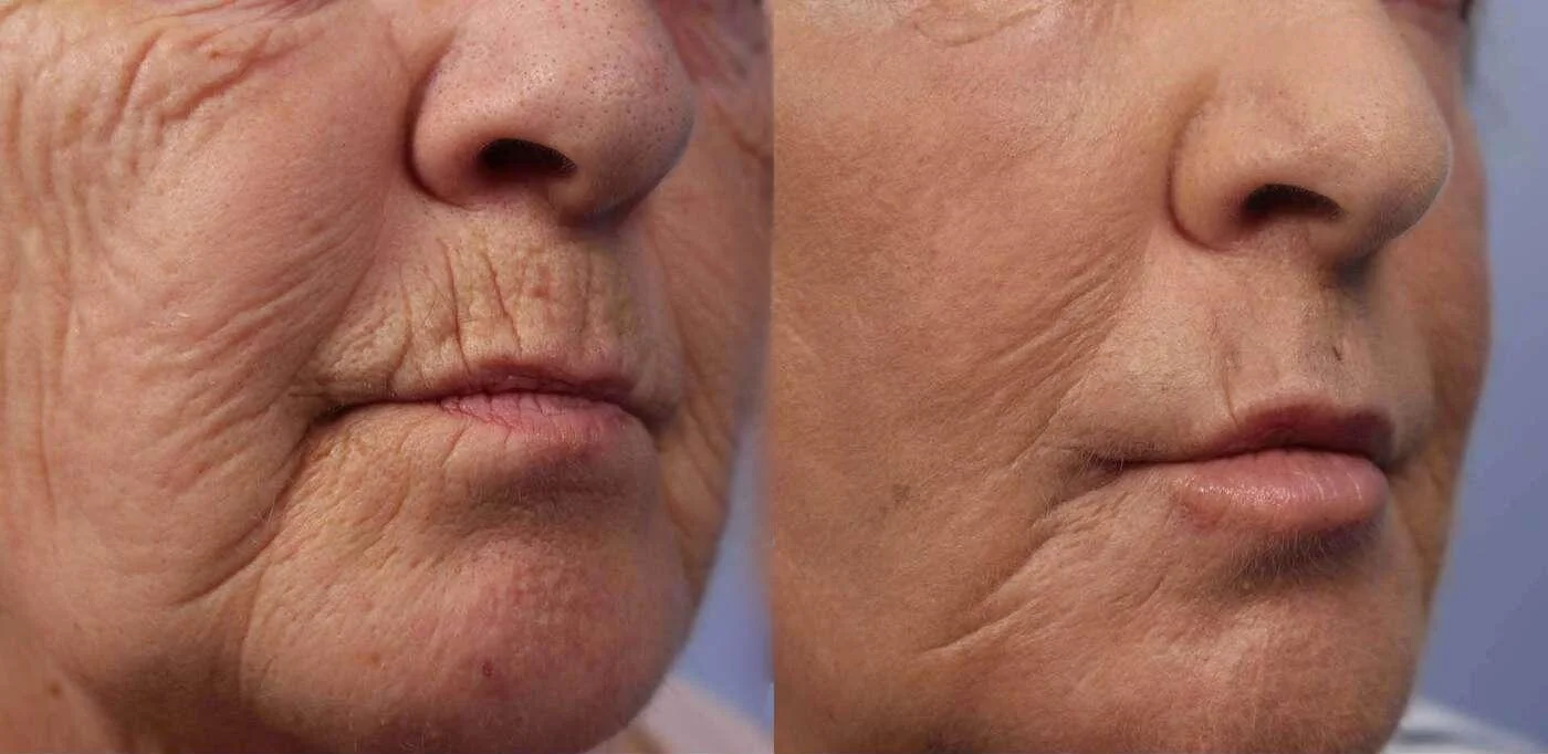 Facetite - Before and After Gallery - Patient Photo 45