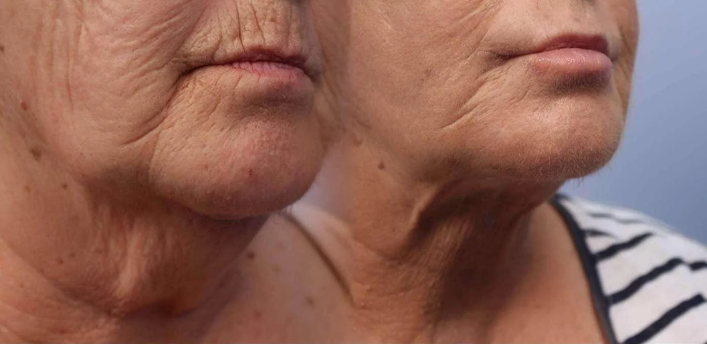 Facetite - Before and After Gallery - Patient Photo 46