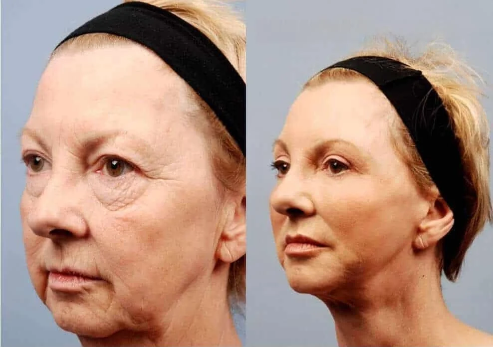Facetite - Before and After Gallery - Patient Photo 5