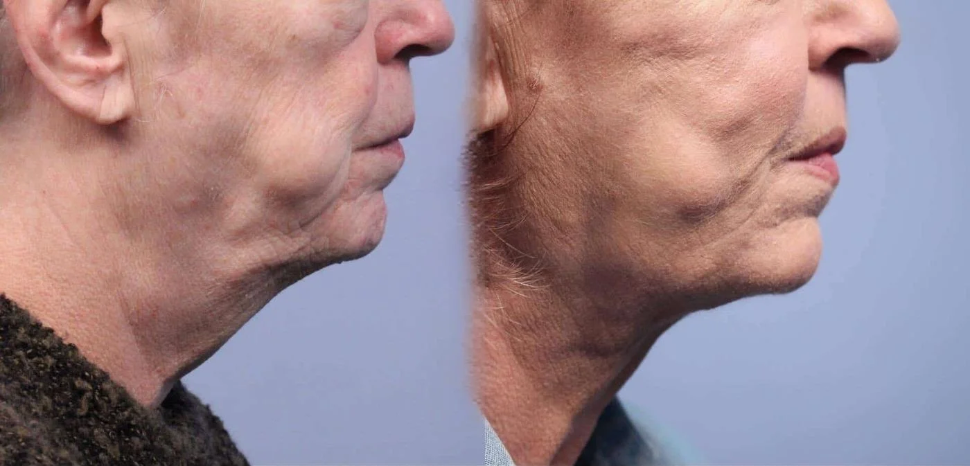 Facetite - Before and After Gallery - Patient Photo 51