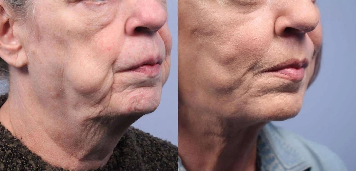 Facetite - Before and After Gallery - Patient Photo 52