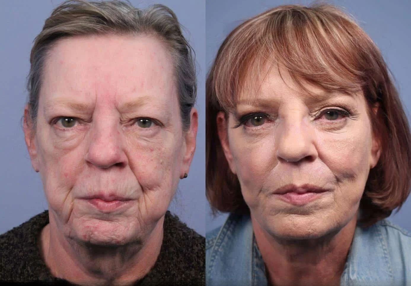 Facetite - Before and After Gallery - Patient Photo 53
