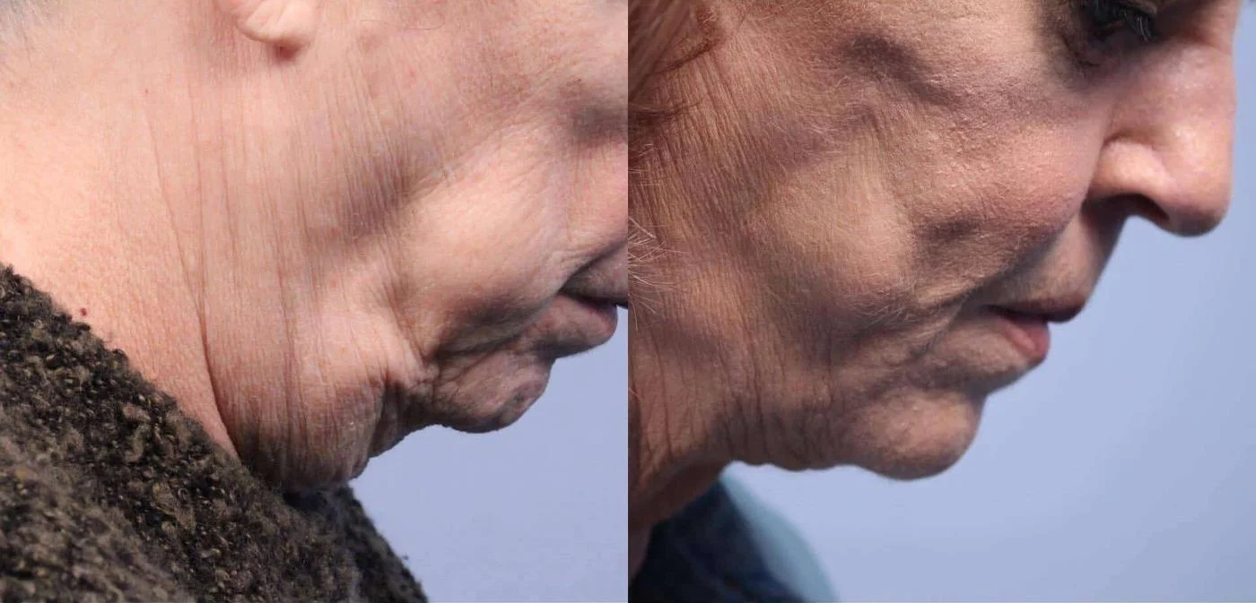 Facetite - Before and After Gallery - Patient Photo 55