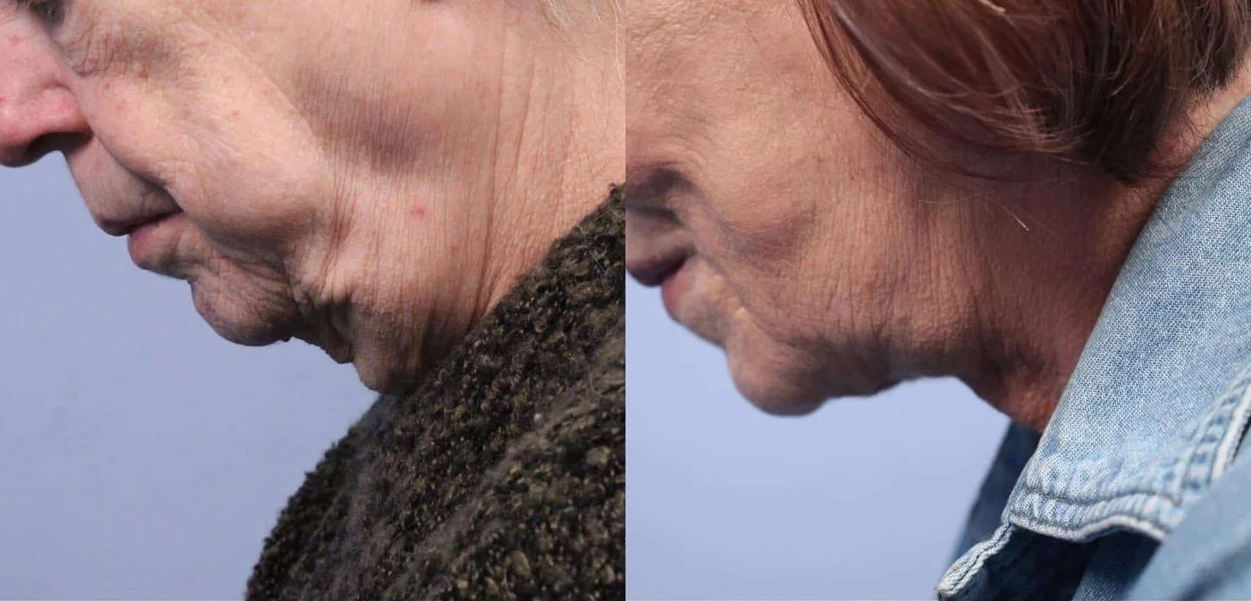 Facetite - Before and After Gallery - Patient Photo 56