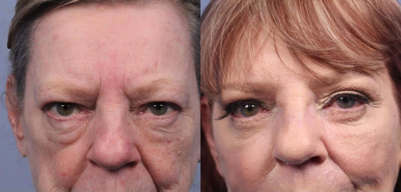 Facetite - Before and After Gallery - Patient Photo 58