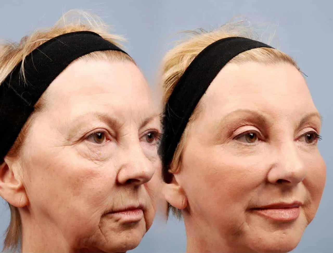 Facetite - Before and After Gallery - Patient Photo 6