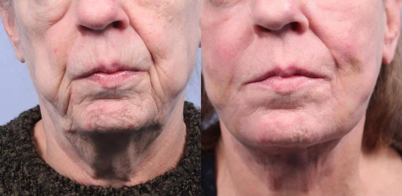 Facetite - Before and After Gallery - Patient Photo 60
