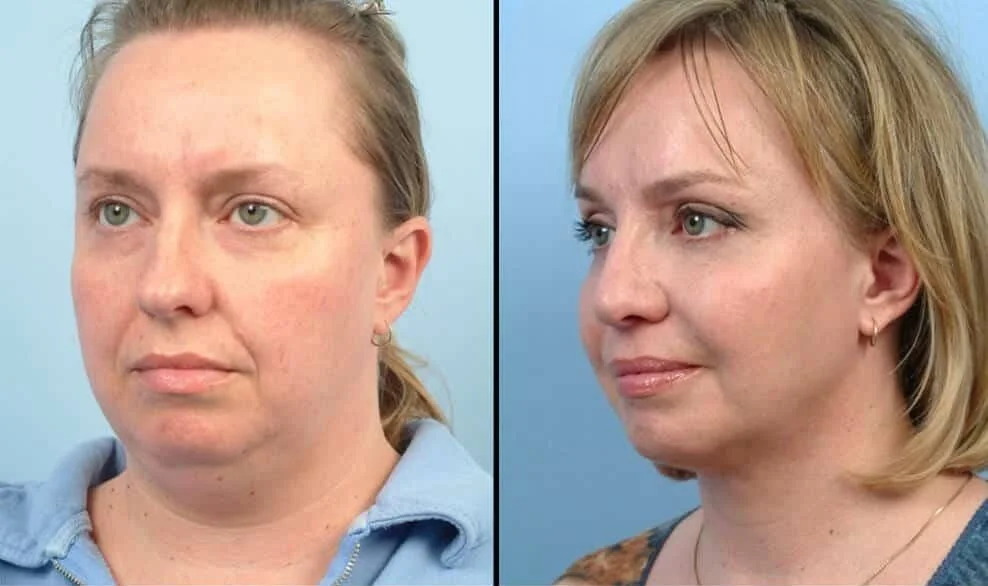 Facetite - Before and After Gallery - Patient Photo 61
