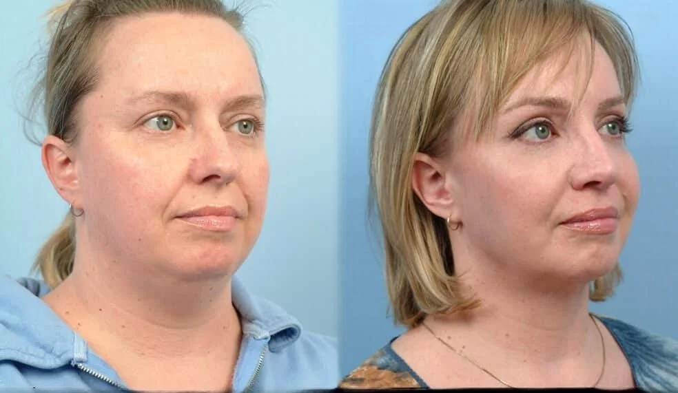Facetite - Before and After Gallery - Patient Photo 62