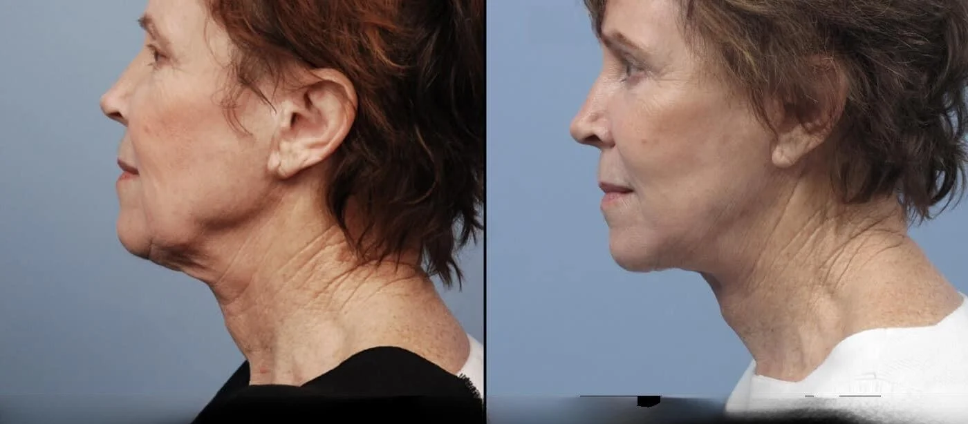 Facetite - Before and After Gallery - Patient Photo 66