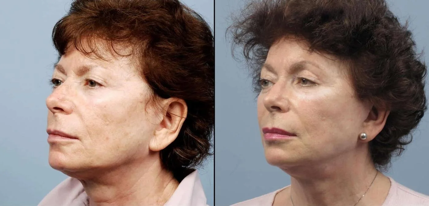 Facetite - Before and After Gallery - Patient Photo 67