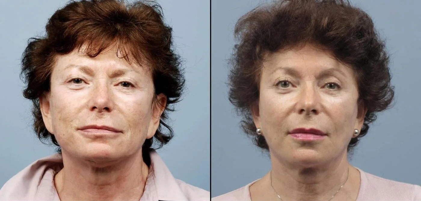 Facetite - Before and After Gallery - Patient Photo 68