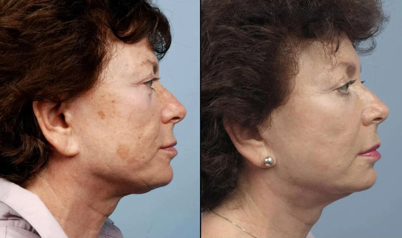 Facetite - Before and After Gallery - Patient Photo 71