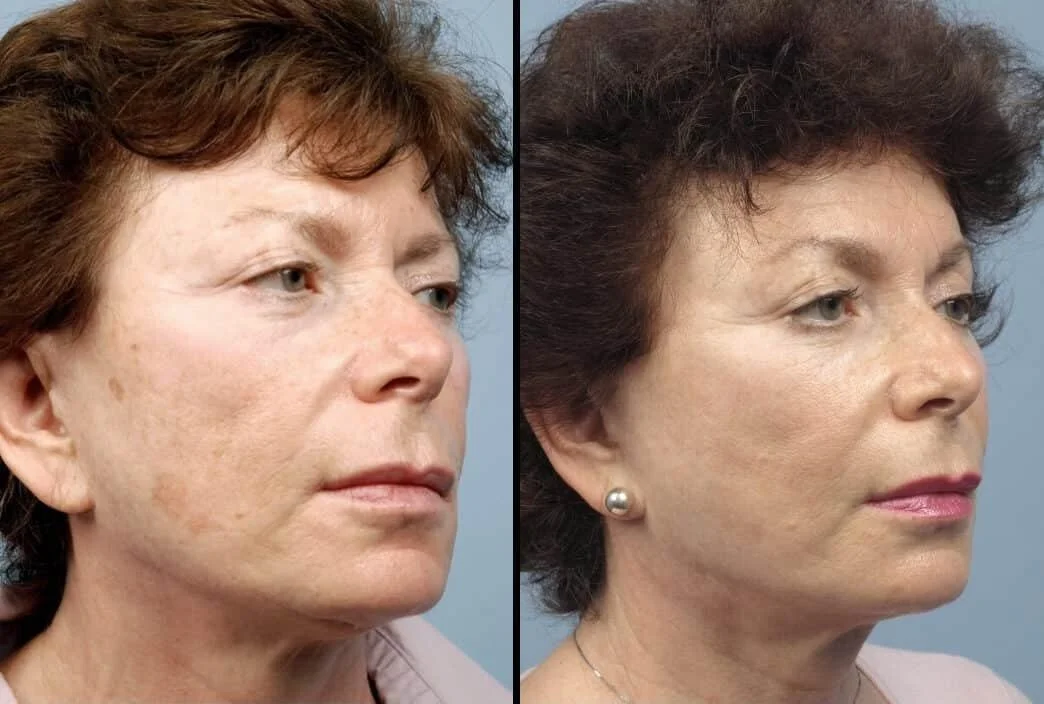 Facetite - Before and After Gallery - Patient Photo 72