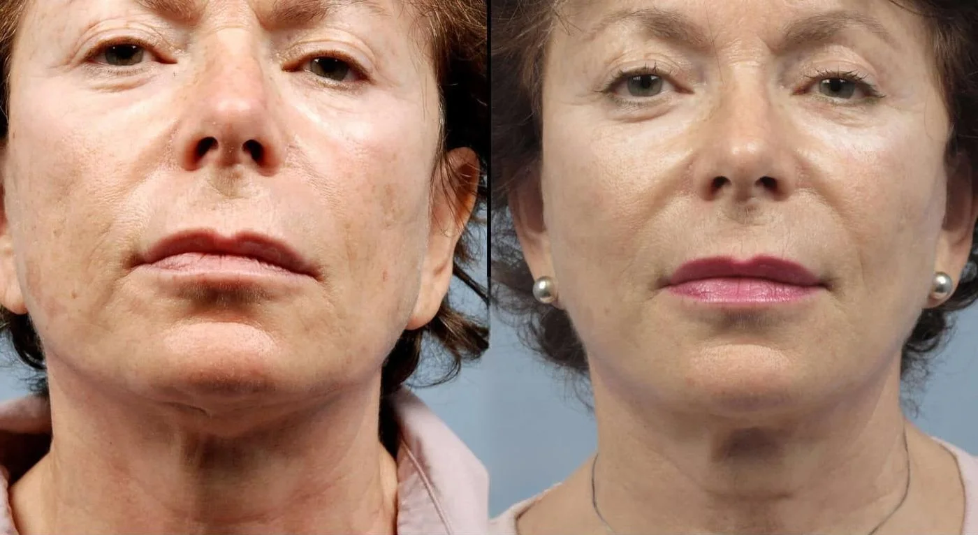 Facetite - Before and After Gallery - Patient Photo 73