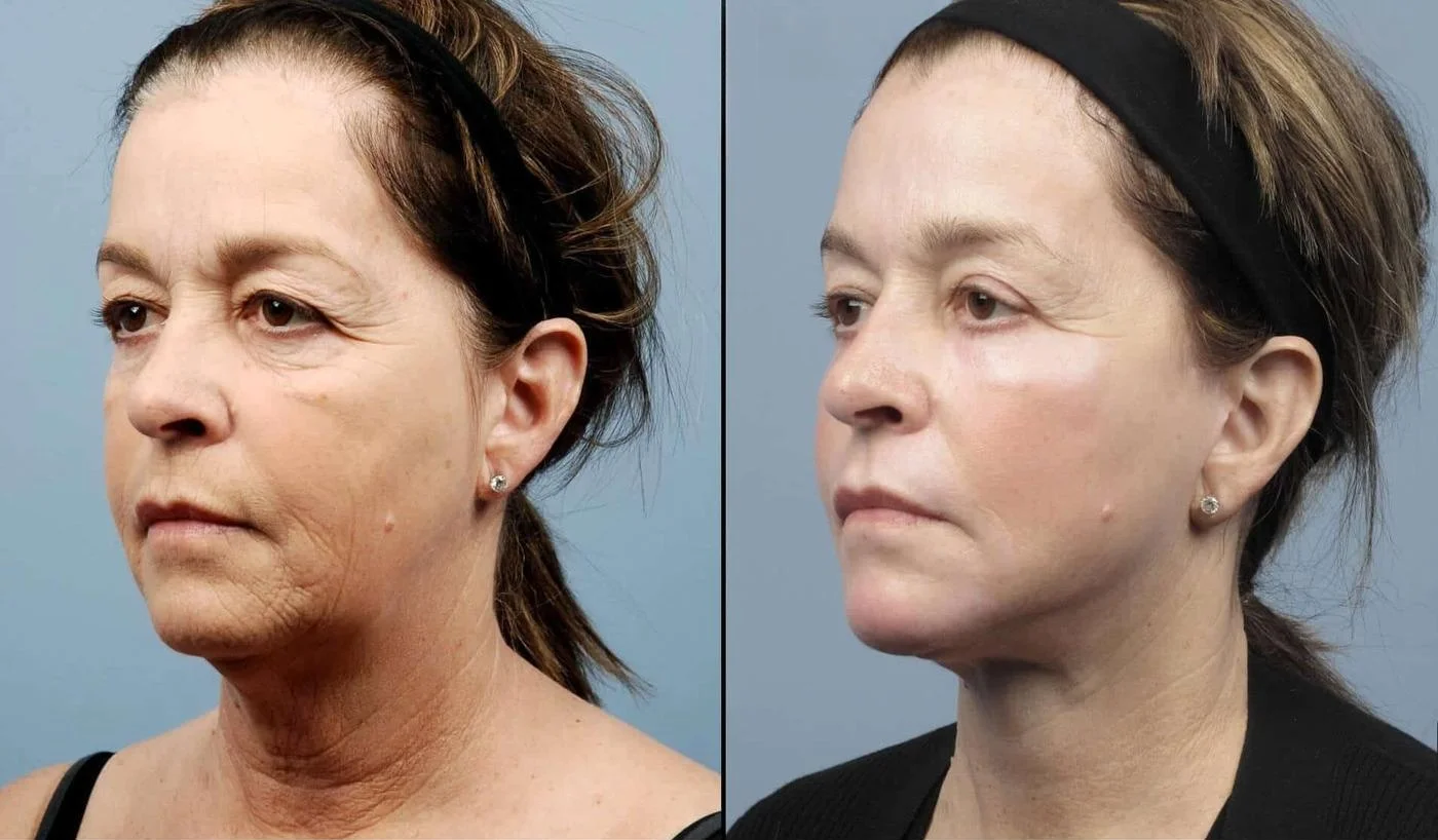 Facetite - Before and After Gallery - Patient Photo 75